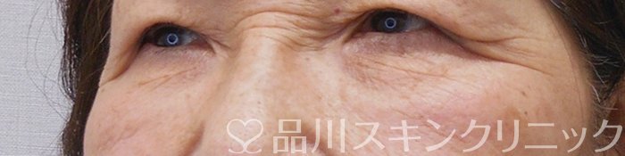症例NO.70023のBEFORE写真
