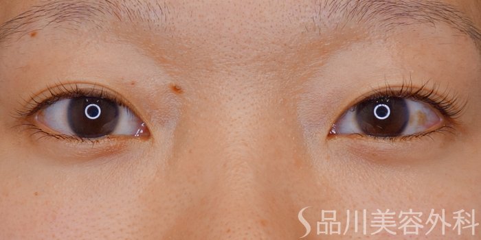 症例NO.72168のBEFORE写真