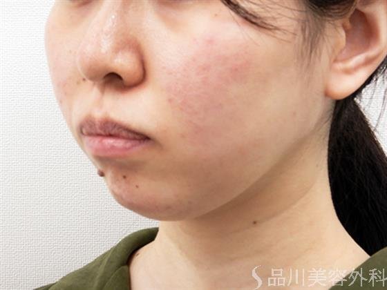 症例NO.53451のAFTER写真