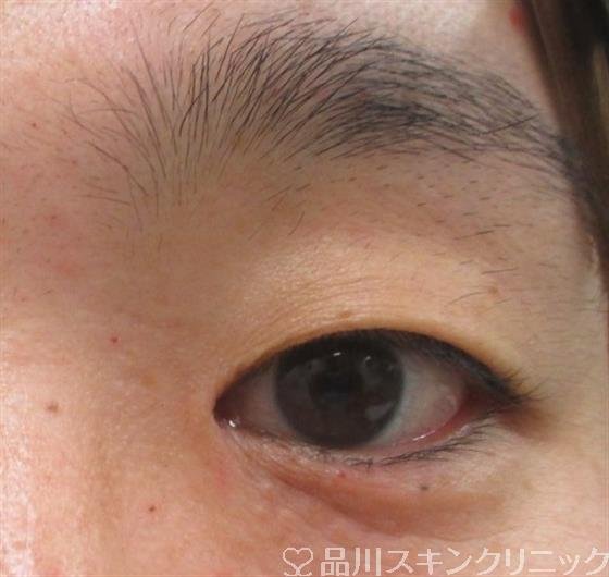 症例NO.27239のBEFORE写真