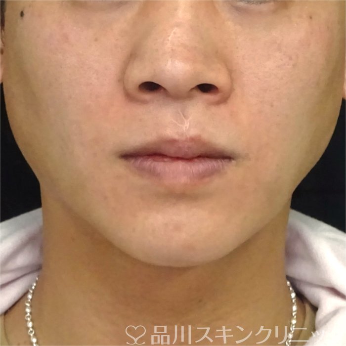 症例NO.69605のBEFORE写真