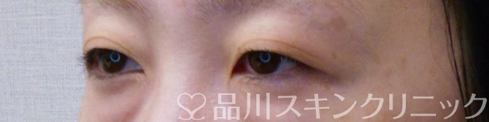 症例NO.74517のBEFORE写真