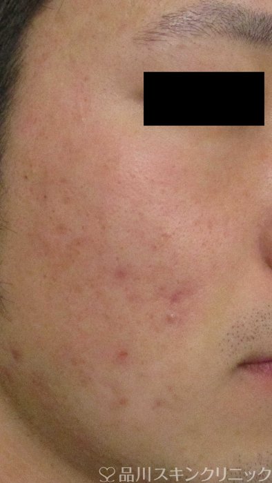 症例NO.70498のBEFORE写真