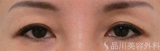 症例NO.26324のBEFORE写真
