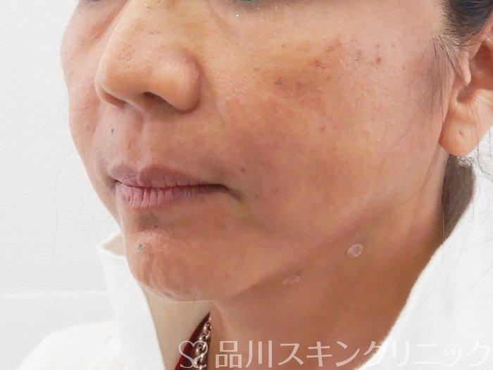 症例NO.63732のAFTER写真