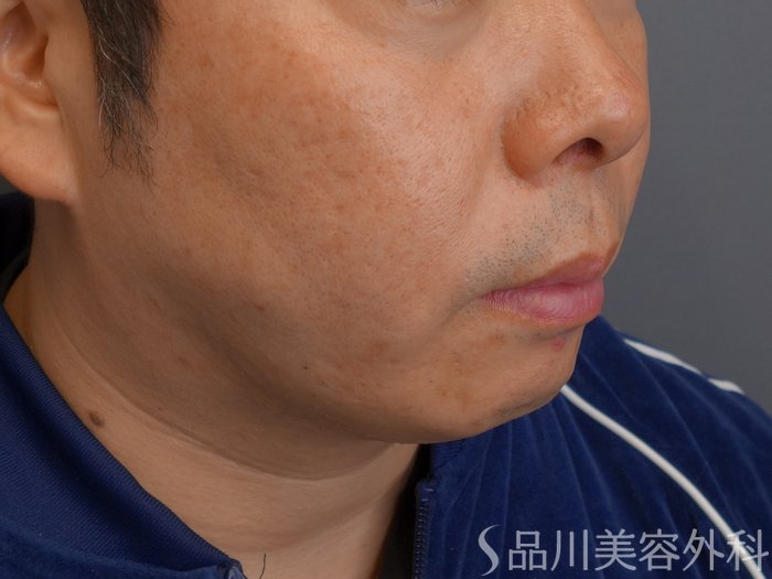 症例NO.75035のAFTER写真