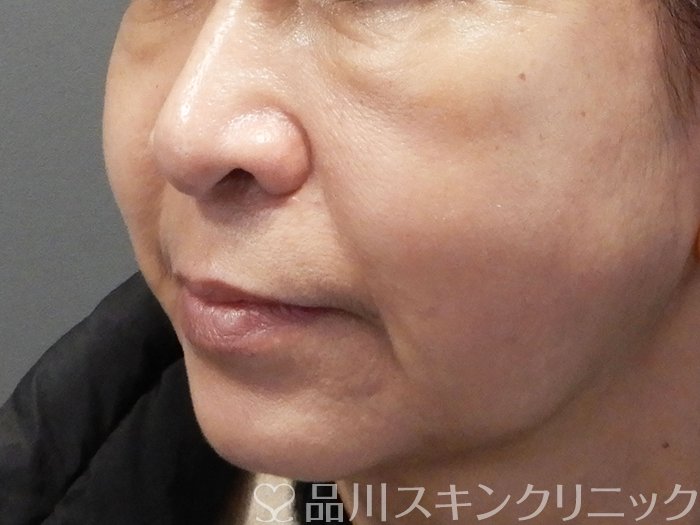 症例NO.72395のAFTER写真