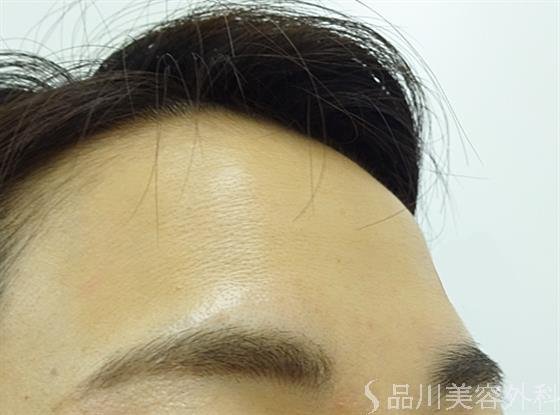 症例NO.39615のBEFORE写真