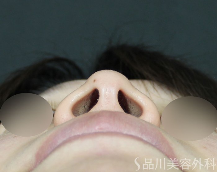 症例NO.72049のBEFORE写真