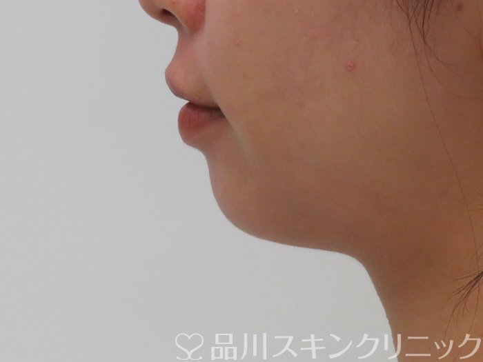 症例NO.65772のBEFORE写真