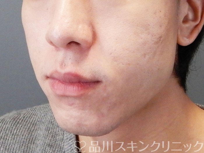 症例NO.73208のAFTER写真