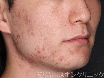症例NO.74115のBEFORE写真