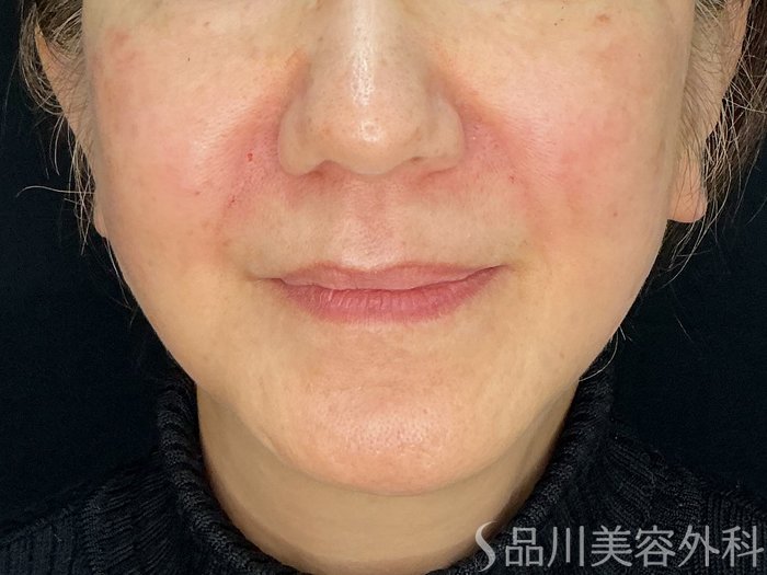 症例NO.72660のAFTER写真