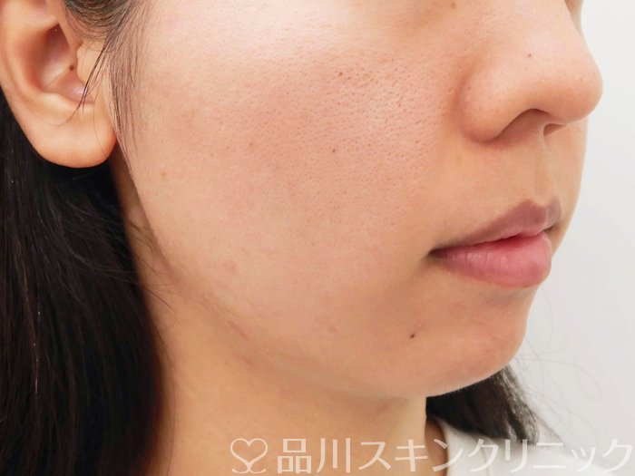 症例NO.62841のBEFORE写真