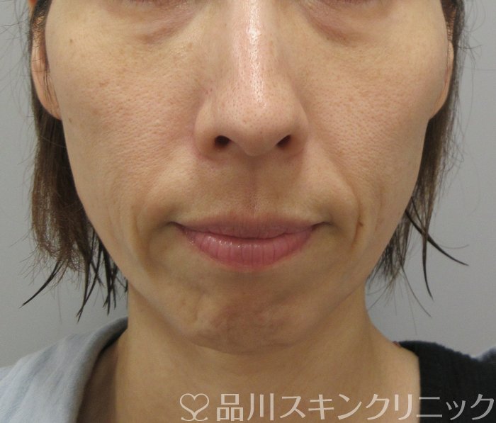 症例NO.74366のBEFORE写真