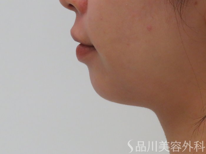 症例NO.65772のBEFORE写真
