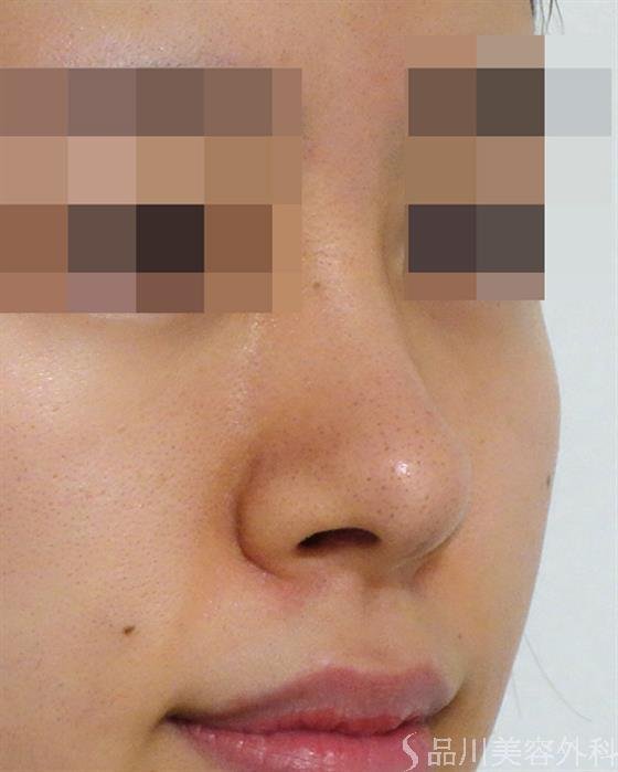 症例NO.47081のBEFORE写真