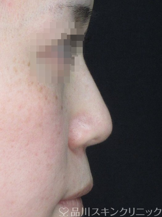 症例NO.73121のAFTER写真