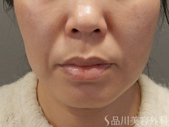 症例NO.69598のBEFORE写真
