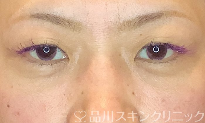 症例NO.71159のAFTER写真