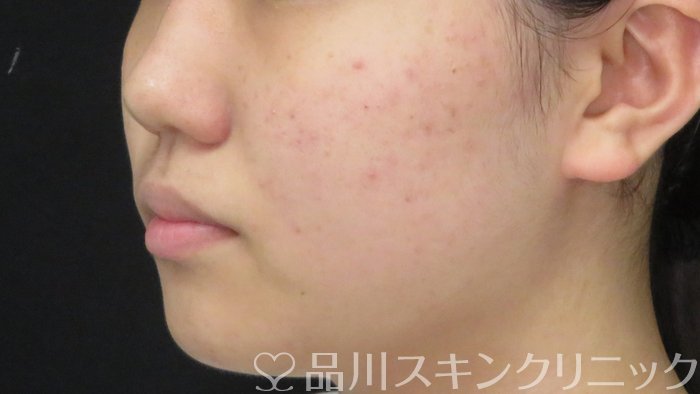 症例NO.71469のBEFORE写真