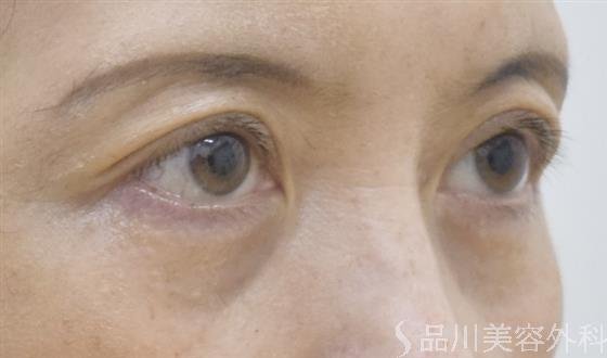 症例NO.52197のAFTER写真