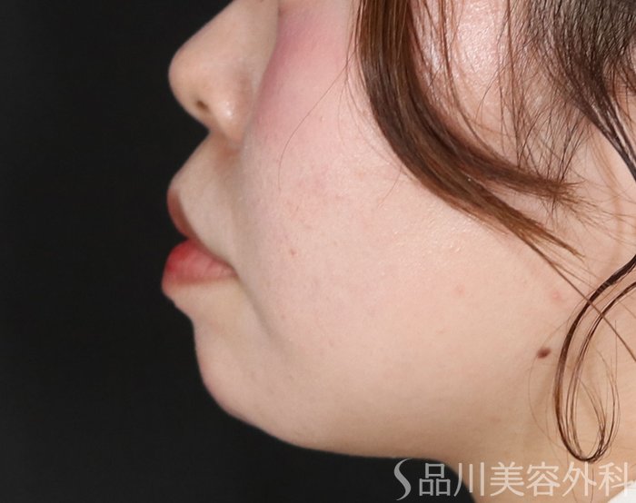 症例NO.72783のAFTER写真