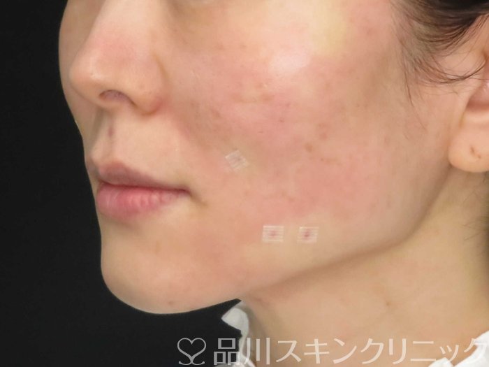 症例NO.62502のAFTER写真