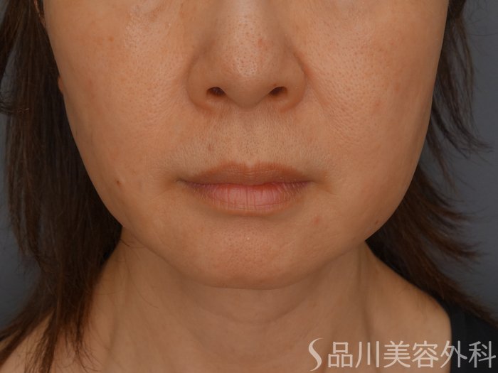 症例NO.65270のBEFORE写真