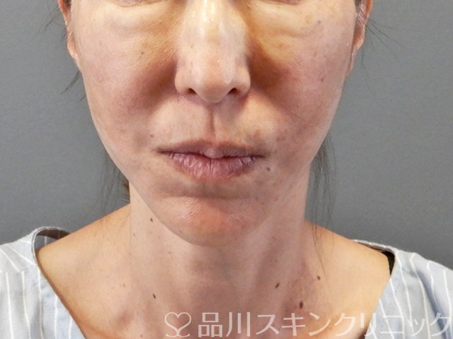 症例NO.66253のAFTER写真