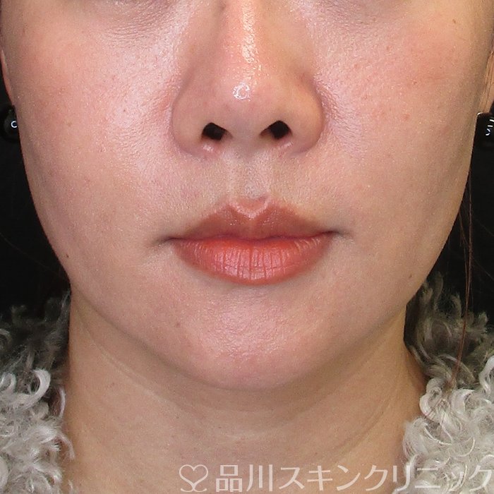 症例NO.73941のBEFORE写真