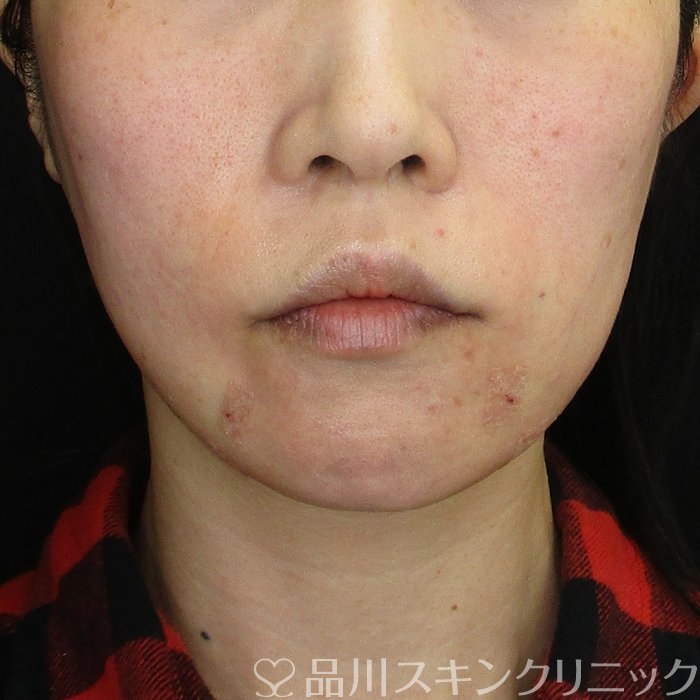 症例NO.74679のAFTER写真