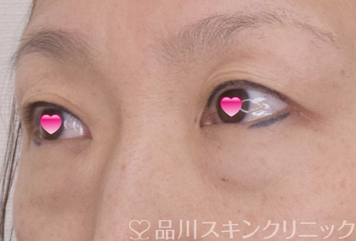 症例NO.69526のBEFORE写真