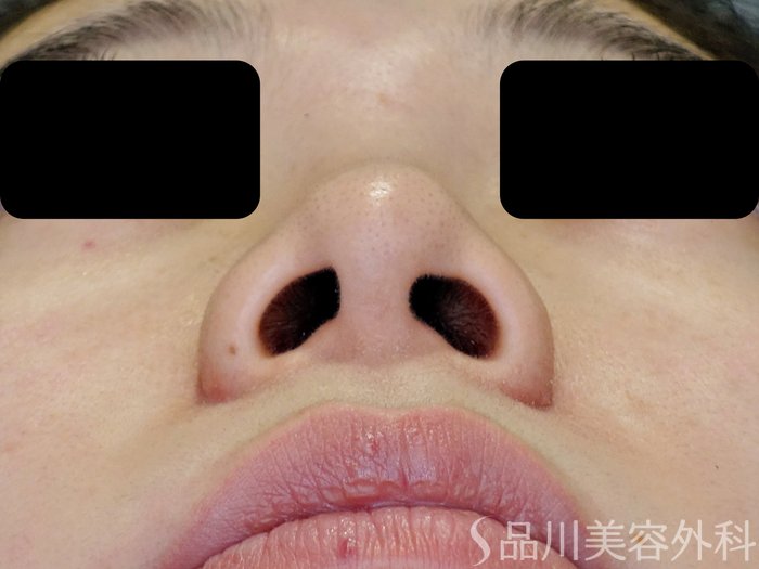 症例NO.71152のBEFORE写真