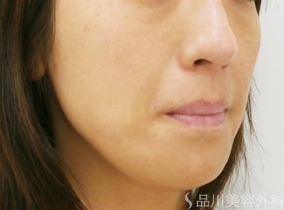 症例NO.30986のBEFORE写真