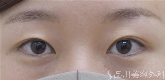 症例NO.51782のBEFORE写真
