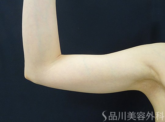 症例NO.75187のBEFORE写真