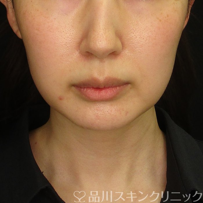 症例NO.70552のBEFORE写真