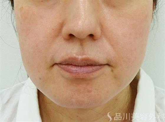 症例NO.49234のBEFORE写真