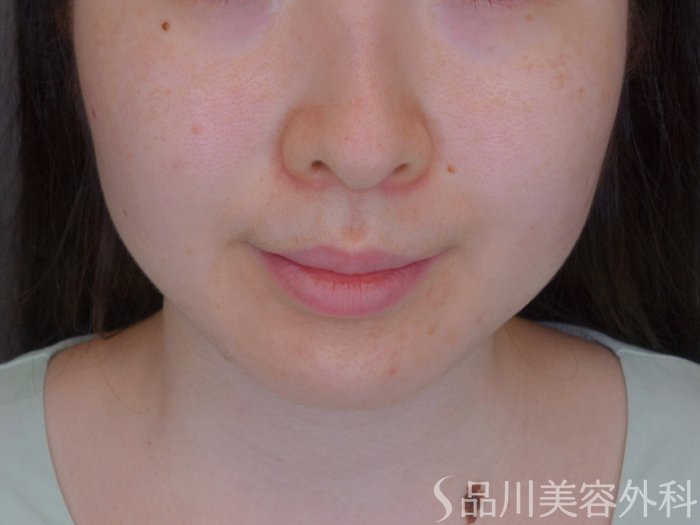 症例NO.74067のBEFORE写真