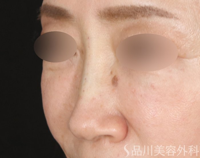 症例NO.72659のAFTER写真
