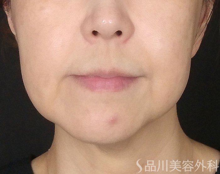 症例NO.65164のBEFORE写真
