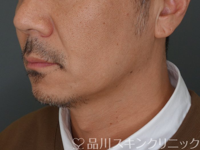 症例NO.72921のBEFORE写真