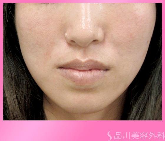 症例NO.1798のAFTER写真