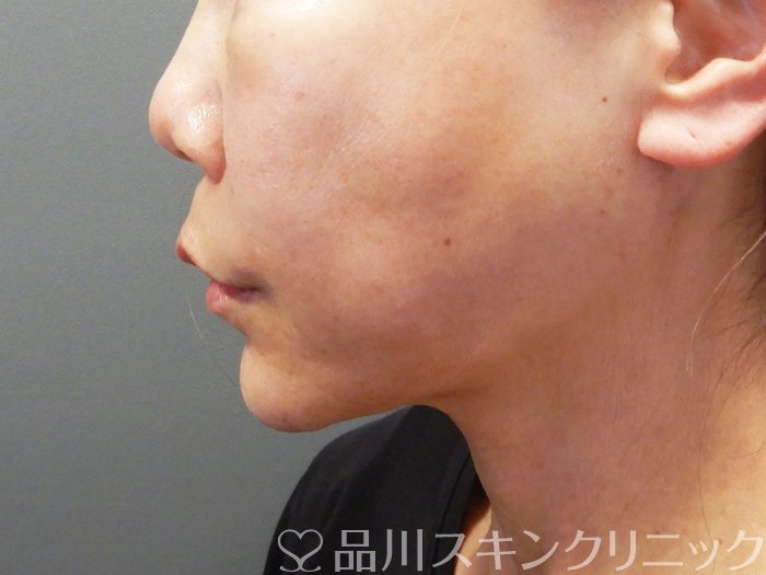 症例NO.72812のAFTER写真