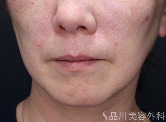 症例NO.73605のAFTER写真