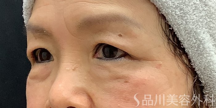 症例NO.63258のBEFORE写真