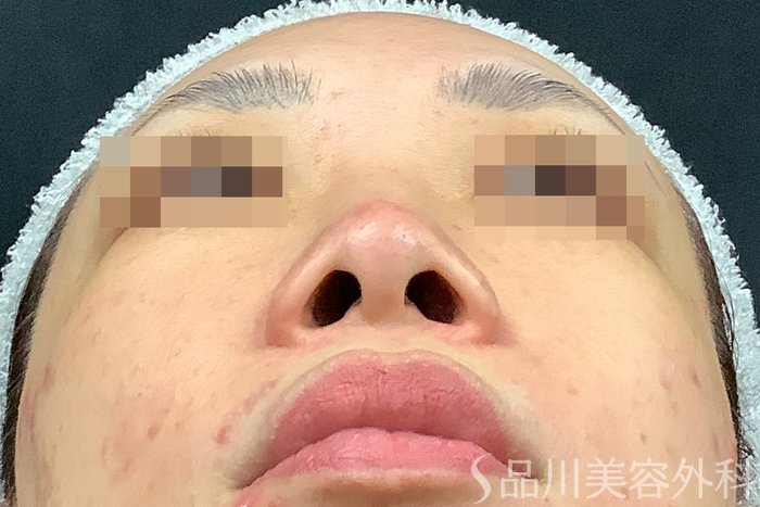 症例NO.71638のBEFORE写真