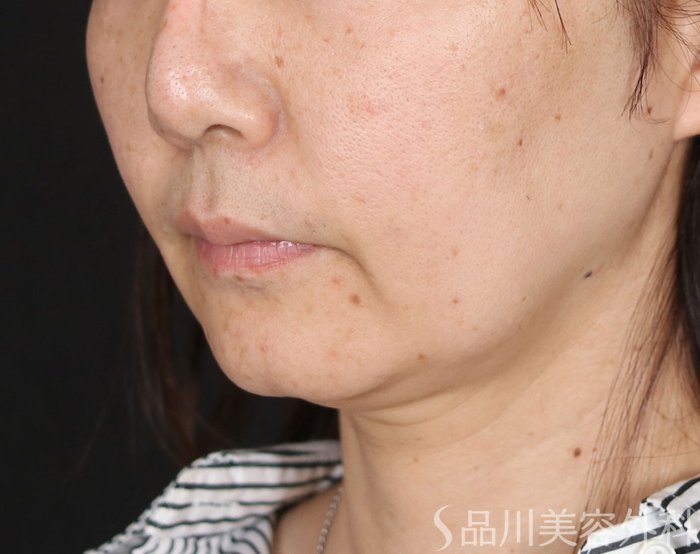 症例NO.71665のBEFORE写真