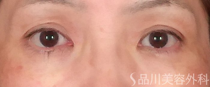 症例NO.70126のAFTER写真